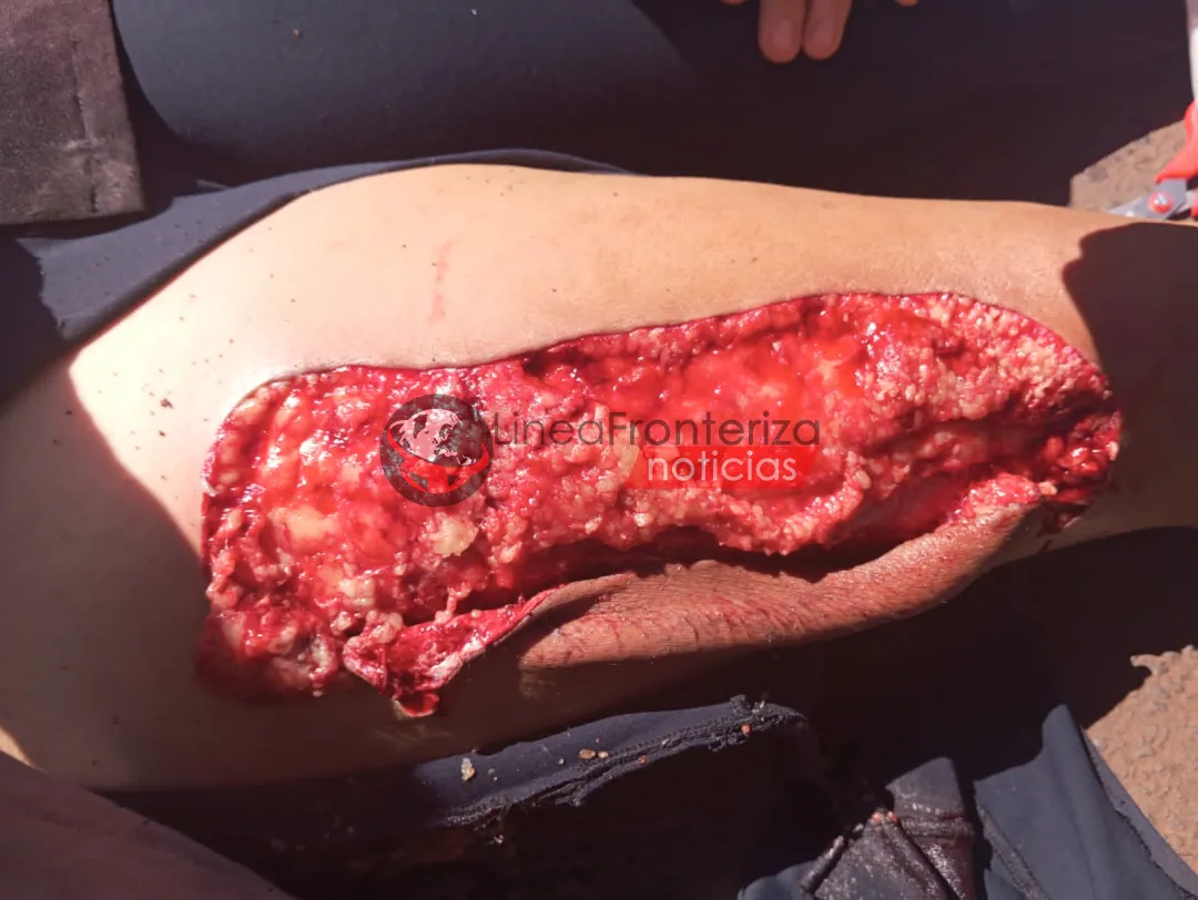 Joven sufre lesión grave en accidente de tránsito