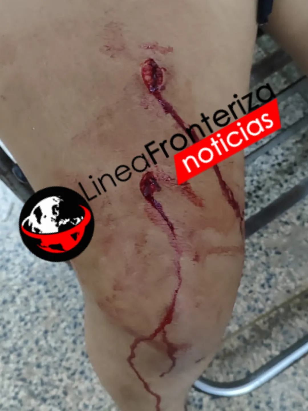Joven herida con arma blanca tras discusión en Fracción Frontera Verde